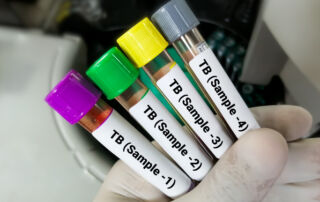 tuberculosis testing Los Angeles